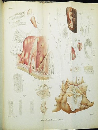 Traité Historique et Pratique de la Syphilis
